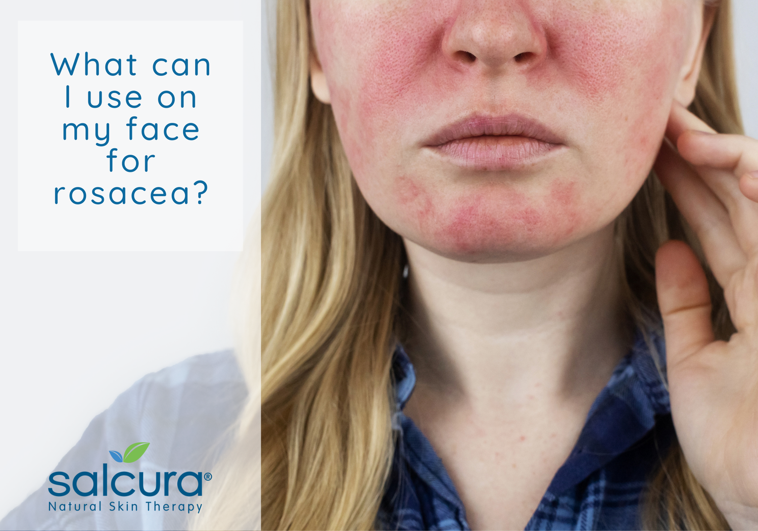 What can I use on my face for rosacea?