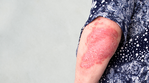 Psoriasis Top Tips To Prevent Flare-Ups