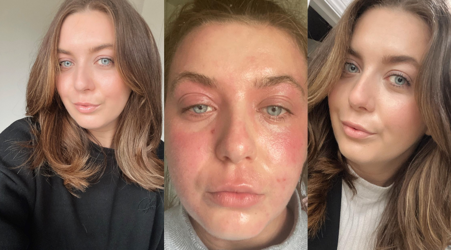 Emily's tips for coping with eczema in the summer
