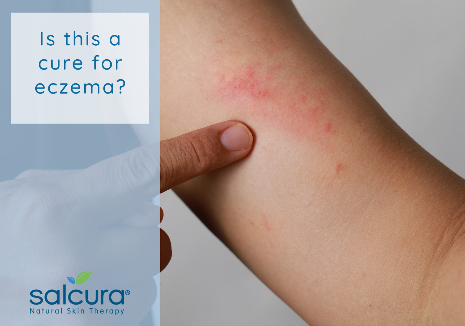 Is this a cure for eczema?