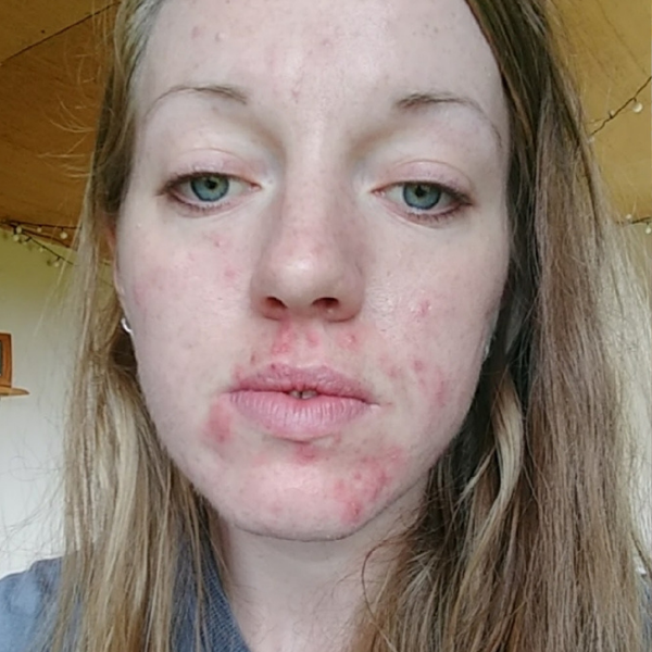 Before - Emily.H